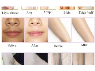 جهاز ليزر لازالة الشعر جديد